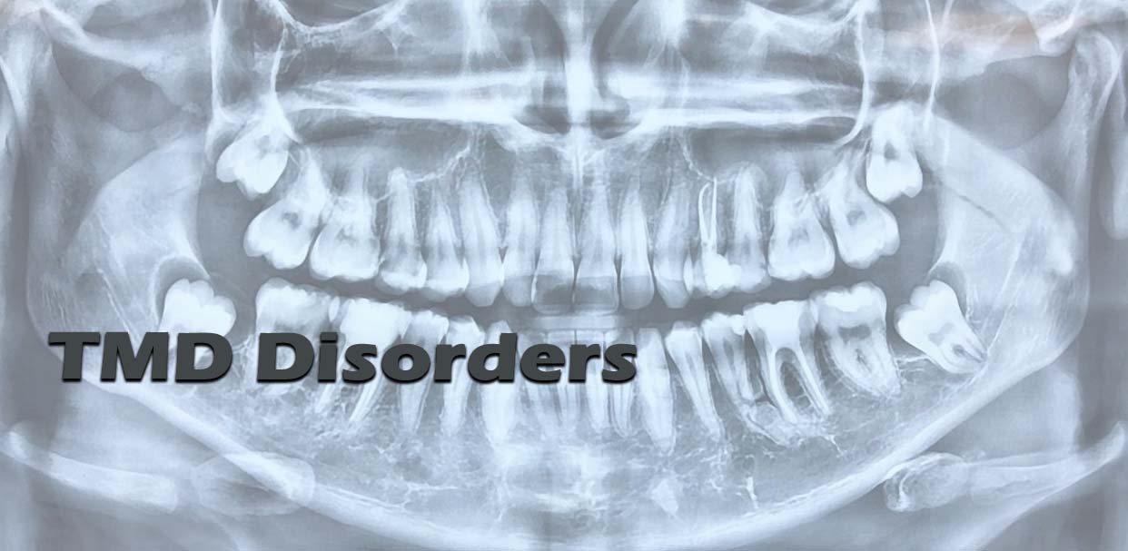 TMD Disorders